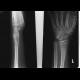 Greenstick fracture of radius and ulna, subperiosteal fracture: X-ray - Plain radiograph